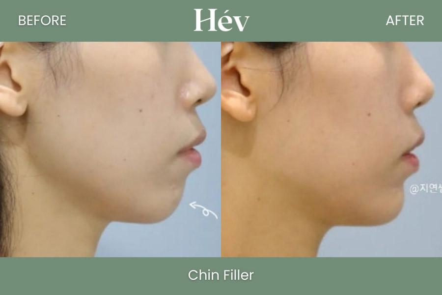Chin Filler