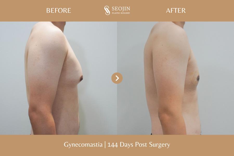 Seojin Plastic Surgery Clinic before and after image