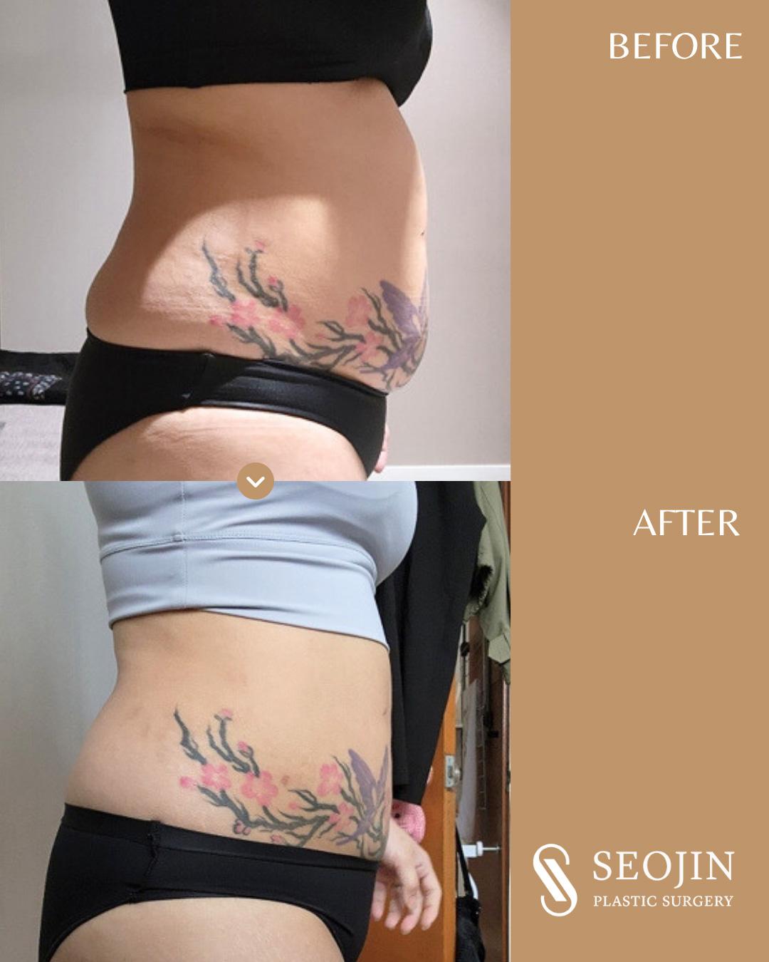 Abdominale Liposuktion