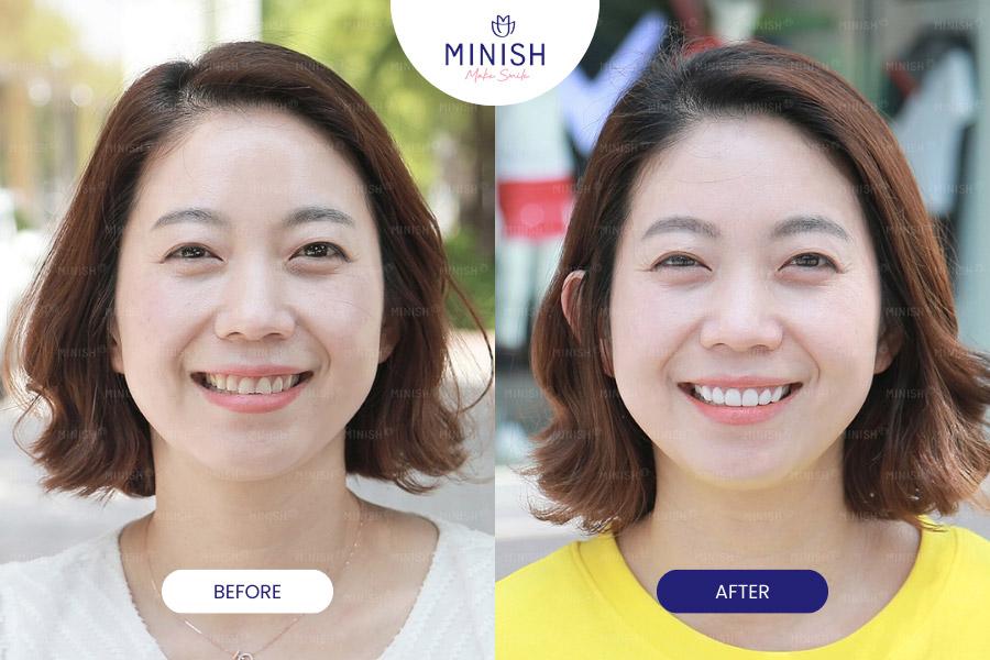 Before after