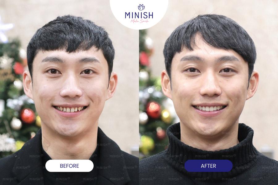 Before and After All-ceramic Veneers