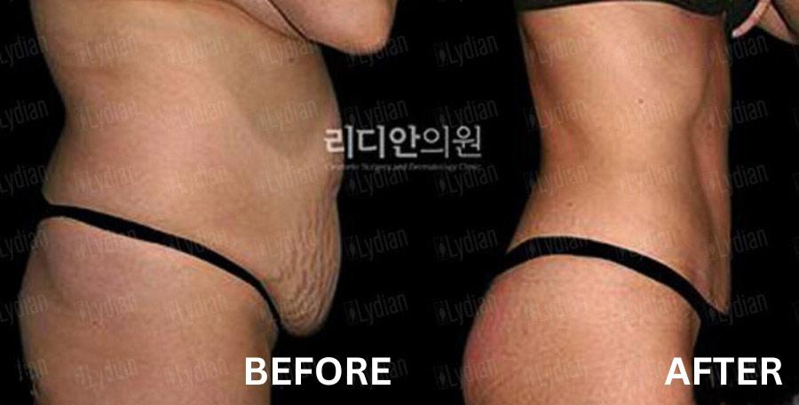 cost tummy tuck korea