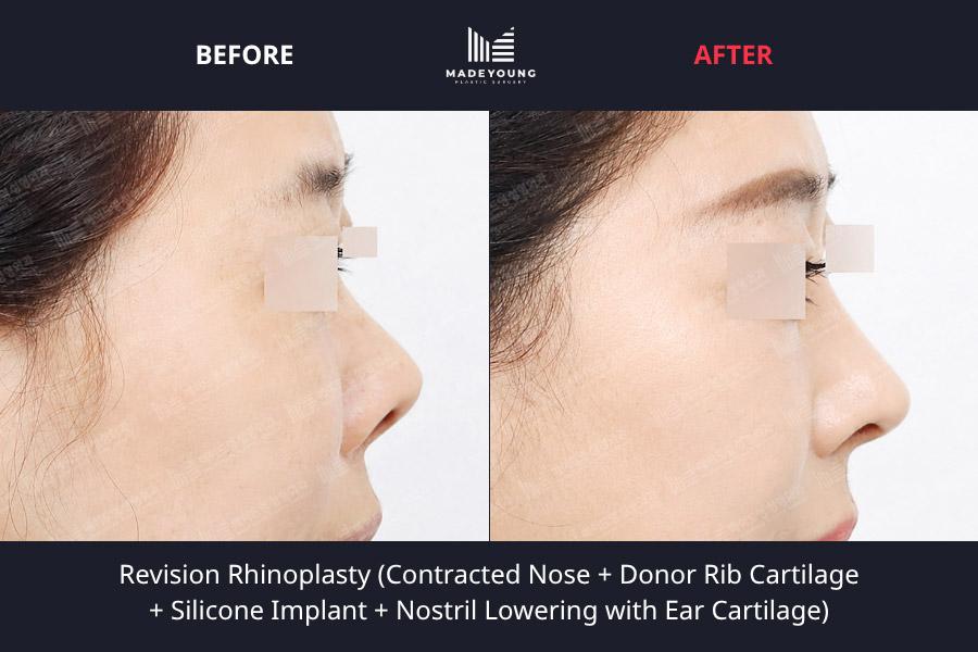 Rhinoplasty contracted nose donor rib cartilage silicone implant nostril lowering ear cartilage