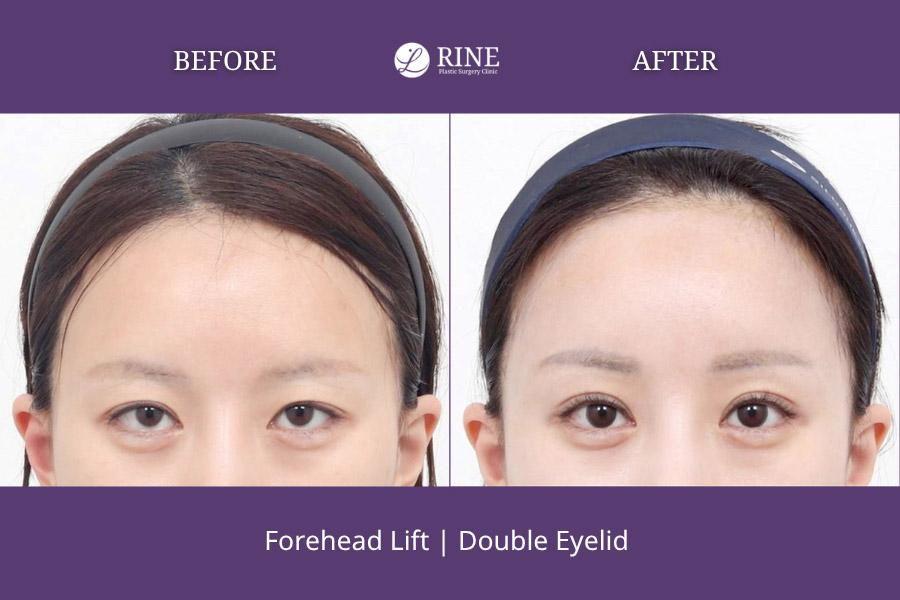 Forehead Lift double eyelid
