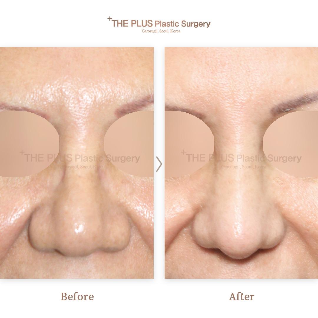 THEPLUS Plastic Surgery before and after image