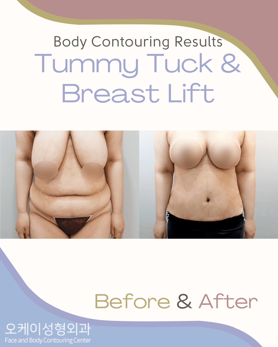 Okay Plastic Surgery Clinic before and after image