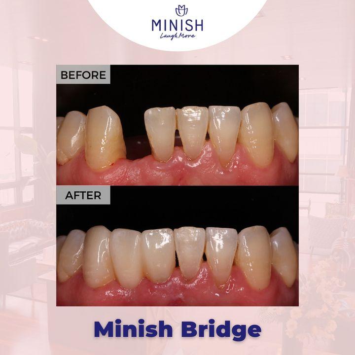 Minish bridges replace missing teeth by minimizing the amount of damage caused to remaining natural teeth.This is done with wing bridges and veneer bridges. We use miniature bridges that can be worn without causing tooth damage.