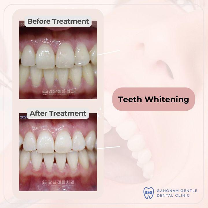 teeth whitening korea