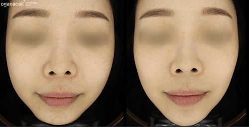 Before and After Ultherapy Lifting