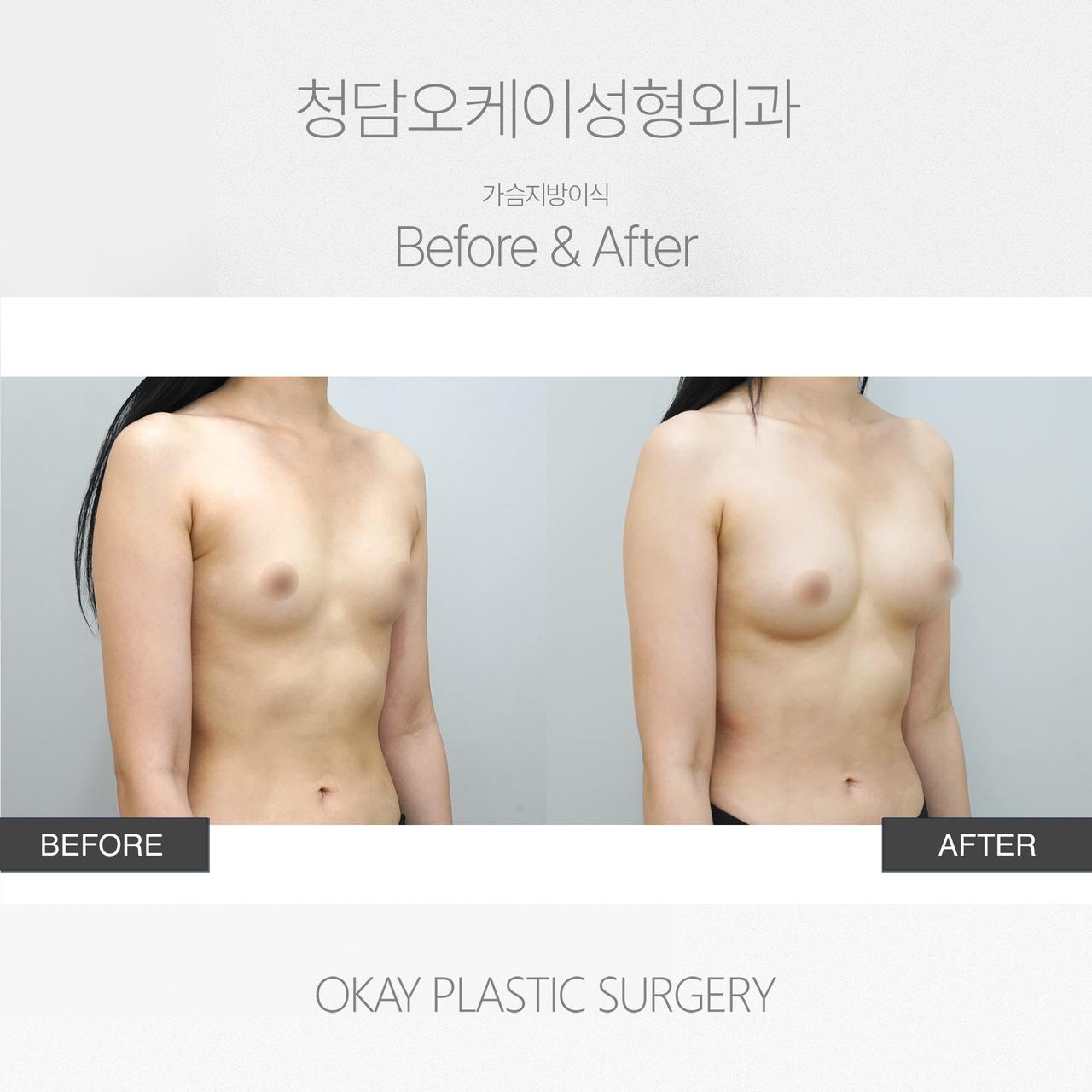 Before and After Breast Fat Grafting