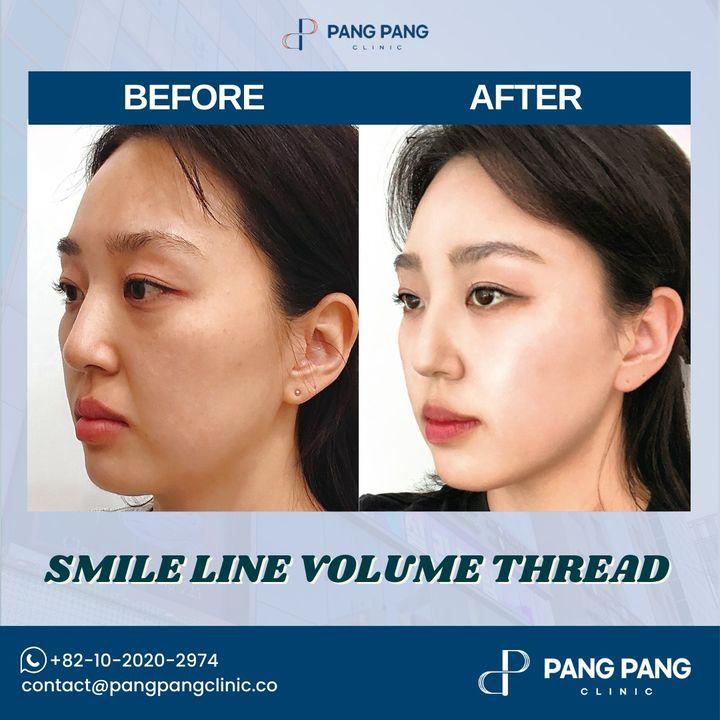 Let your smile radiate with confidence. PangPang's Smile Line Volume Thread delivers a subtle, uplifting enhancement, framing your joy with the beauty it deserves.