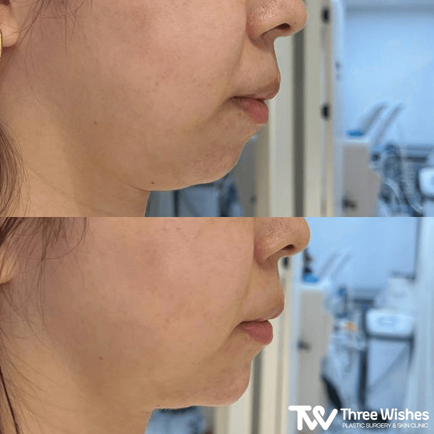 Three Wishes Clinic - Myeongdong before and after image