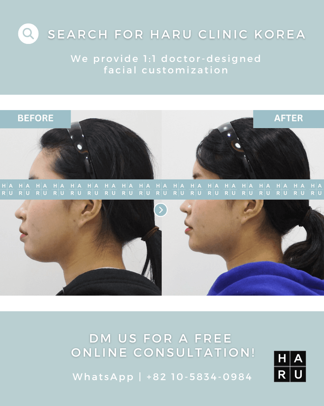 Lippenfiller, Botox zum Anheben der Mundwinkel, Fadenlifting, fettauflösende Injektion, Kinn-Botox, Kinnfiller