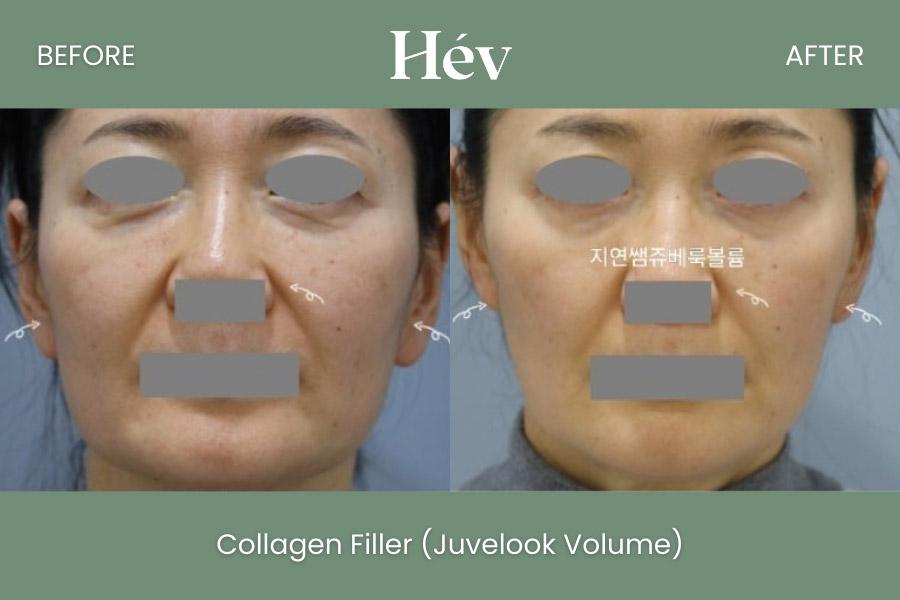 Collagen Filler Jubelook Volume