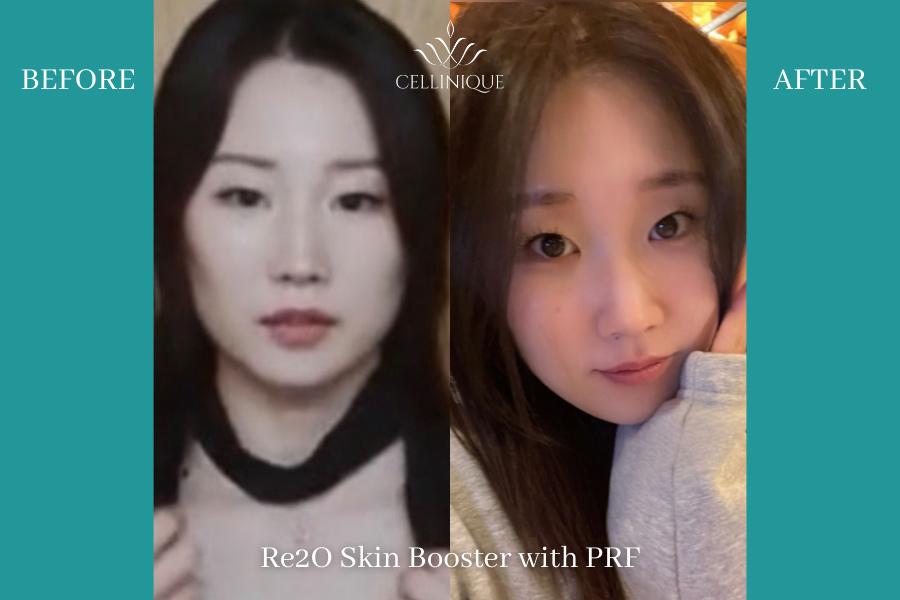 Before and After PRF Injection