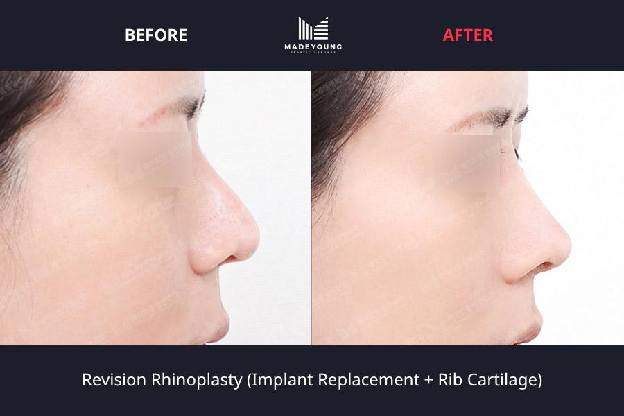 Rhinoplasty implant replacement rib cartilage