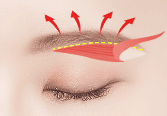 Eyebrow Lift