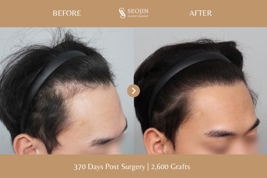 Seojin Plastic Surgery Clinic before and after image