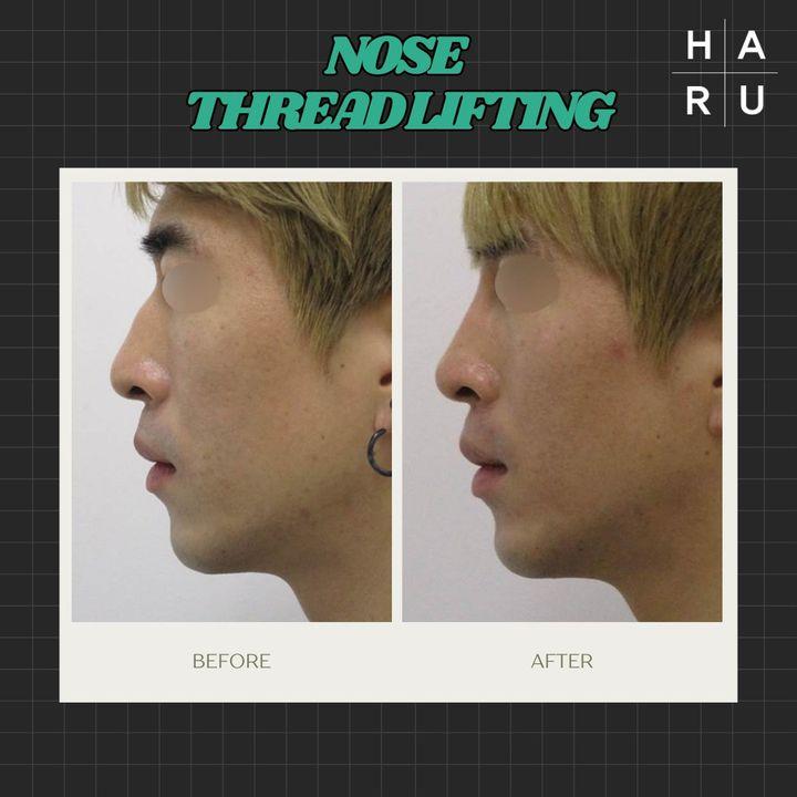 nose thread lift korea