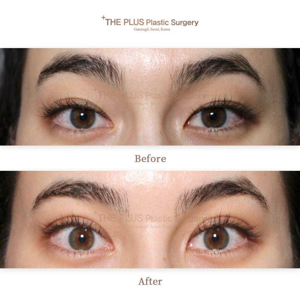Ptosis Correction