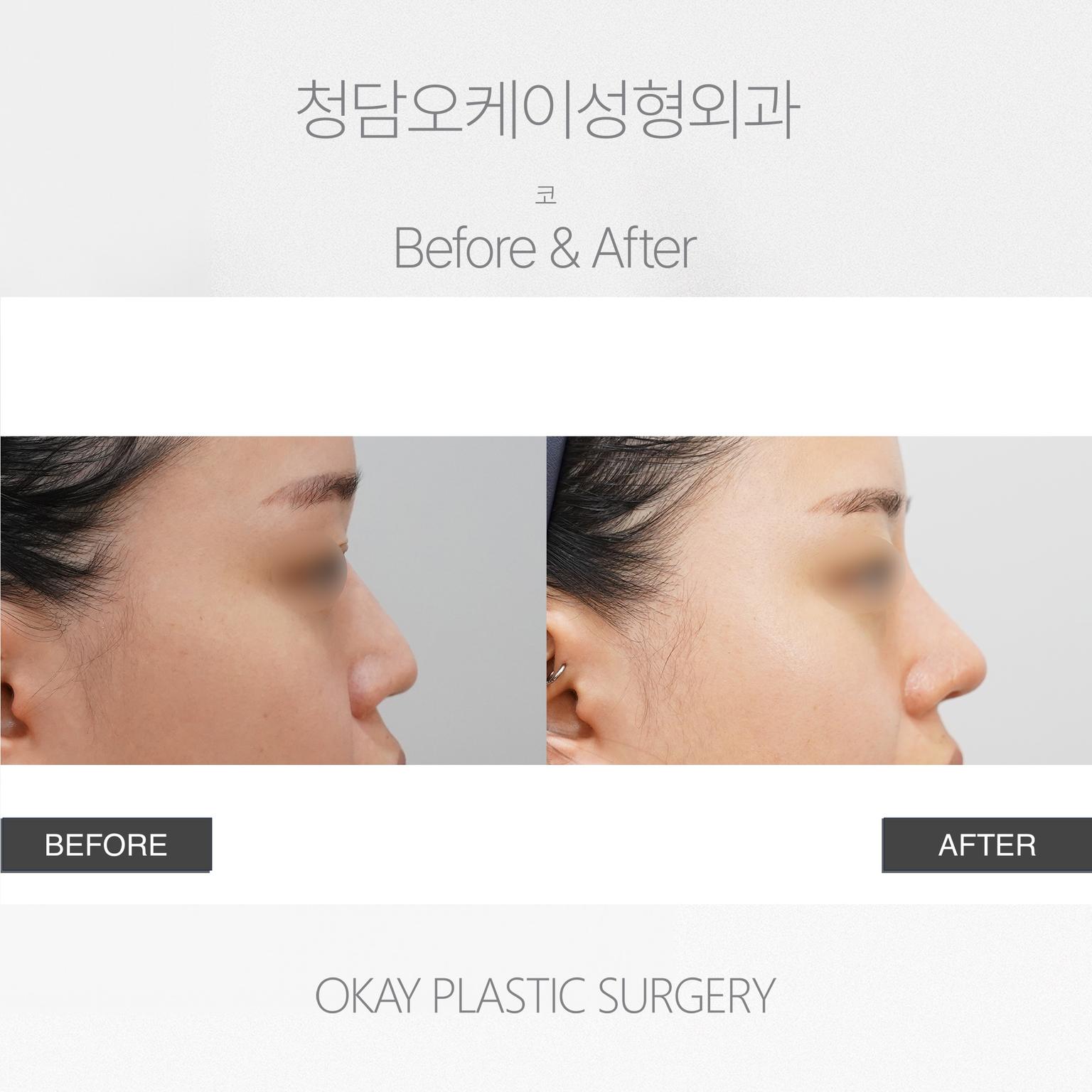 Okay Plastic Surgery Clinic before and after image