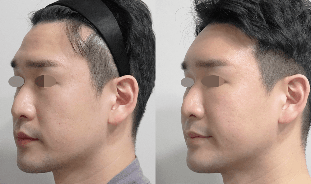 Before and After Stem Cell Facial