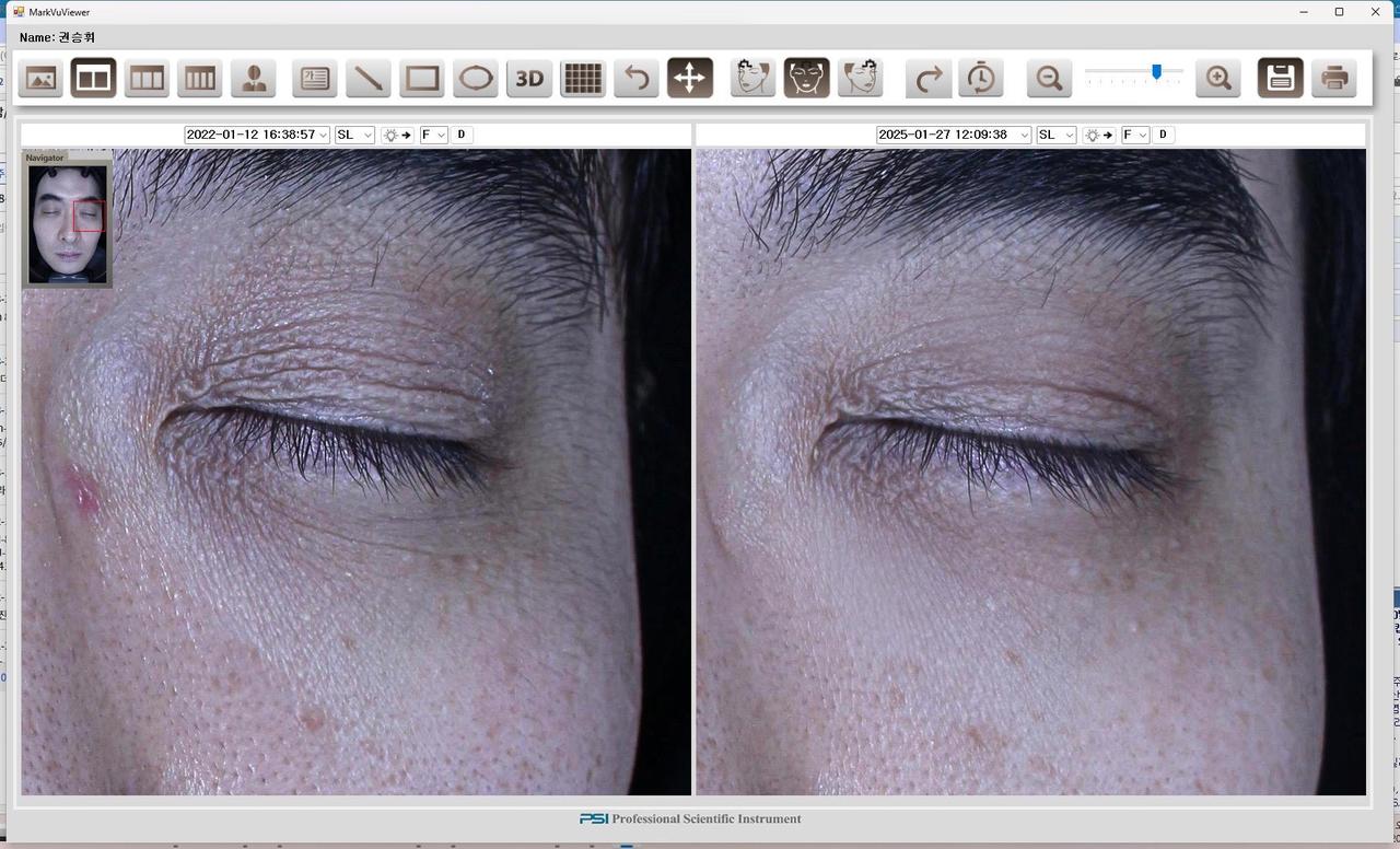 Before and After Thermage Lifting