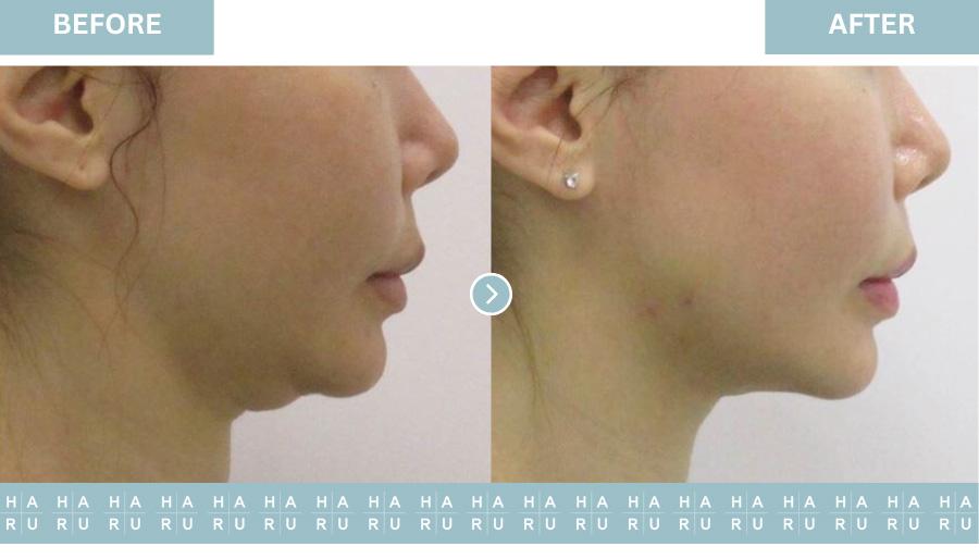 Double Chin Thread Lift with Elasticum