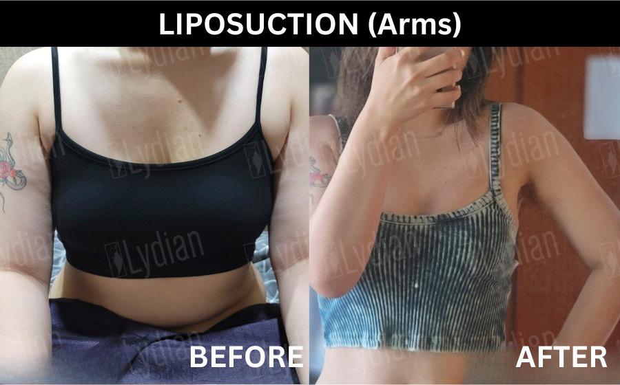 cost arm liposuction korea