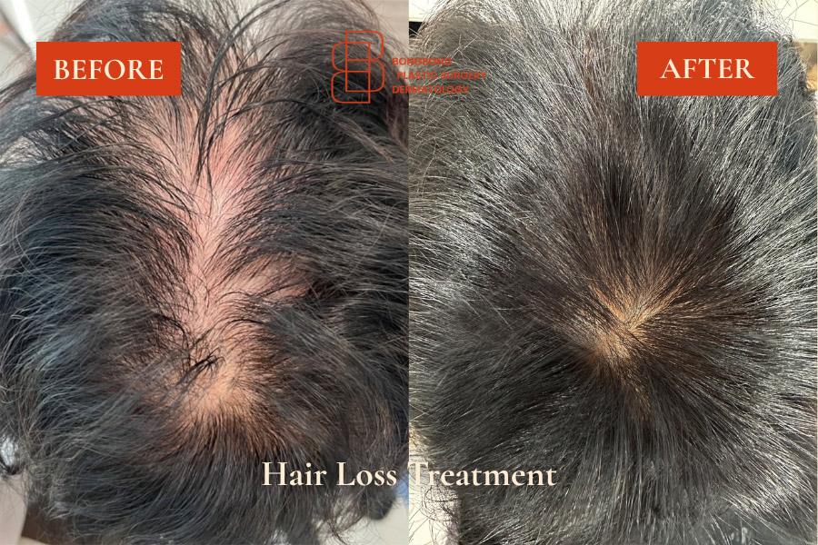 Before and After Hair Loss Treatment