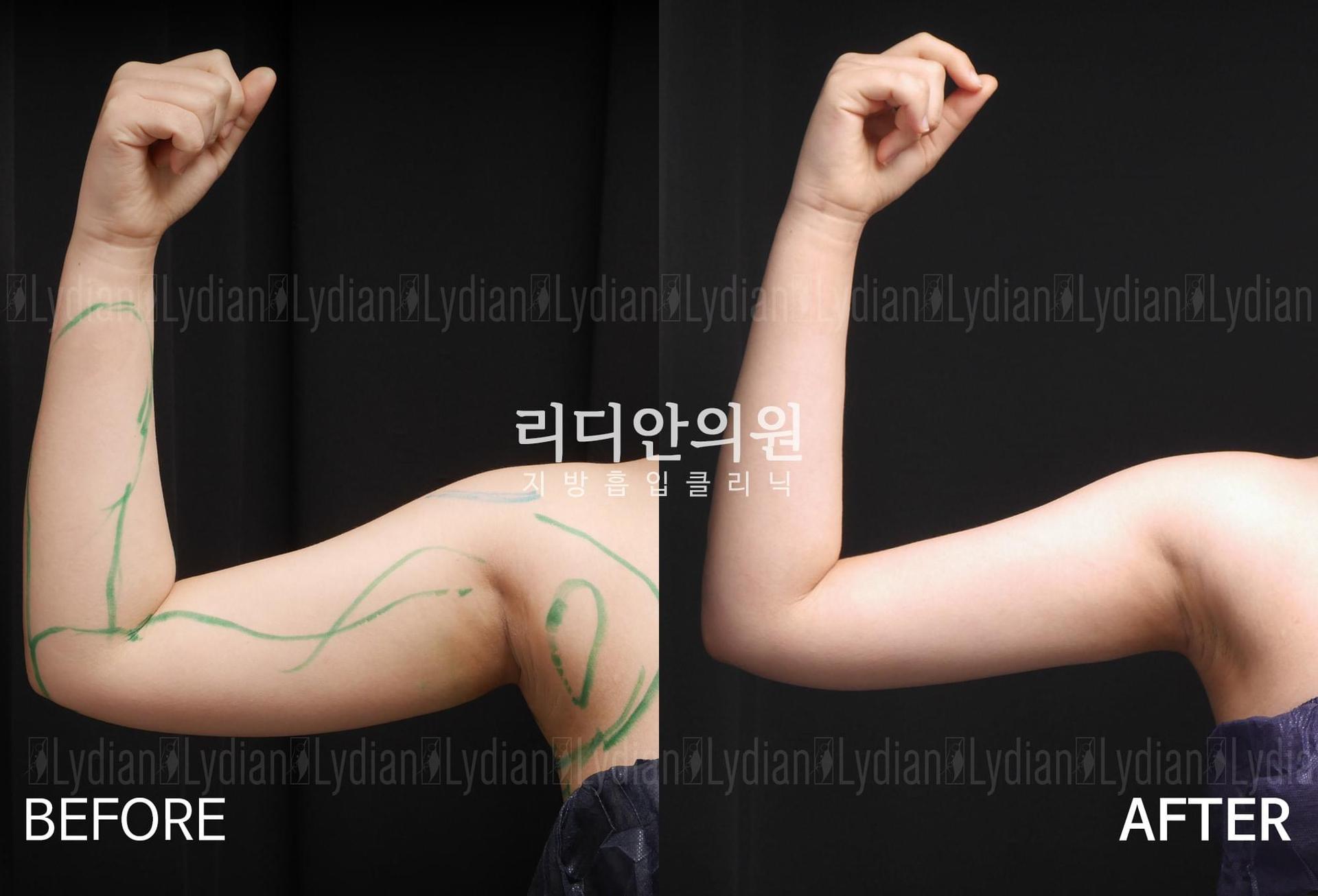 lydian-female-arm-liposuction-01.jpg