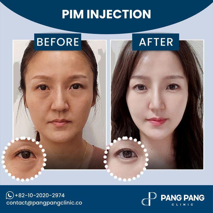 Volumenverlust und Falten? Behandeln Sie beides gleichzeitig mit unserer PIM-Injektion. Verbessern Sie Ihr Gesichtsvolumen und glätten Sie Falten in nur 30 Minuten. Unsere Lifting-Injektionen, reich an modernen resorbierbaren Fadenkomponenten, fördern die Kollagenproduktion für natürliches Volumen und festere Haut.