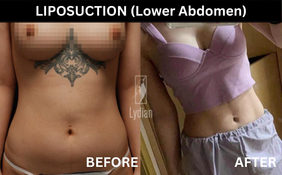 Lydian Plastic Surgery Clinic before and after image