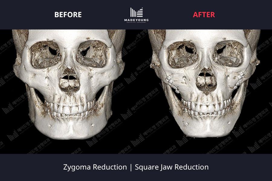 Reduction square jaw reduction 1