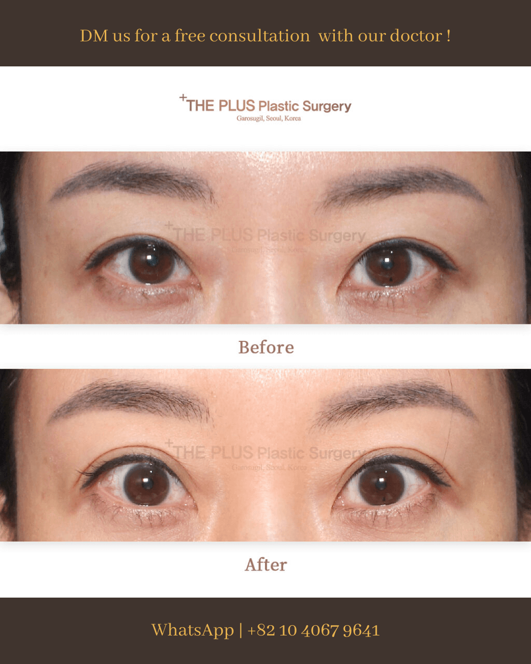 Revision Eye Surgery, Double Eyelid Surgery