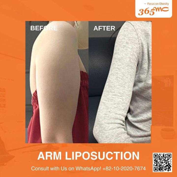 Sculpted arms are within reach. Our arm liposuction results are a testament to precision and care.
