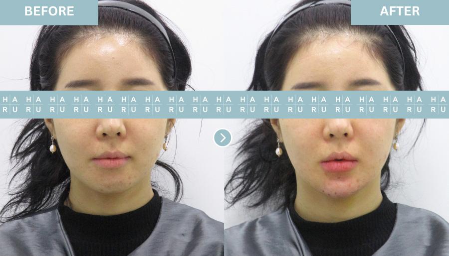 Before and After Chin Filler