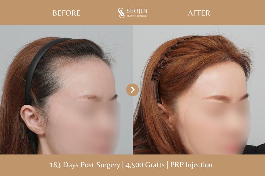 Seojin Plastic Surgery Clinic before and after image