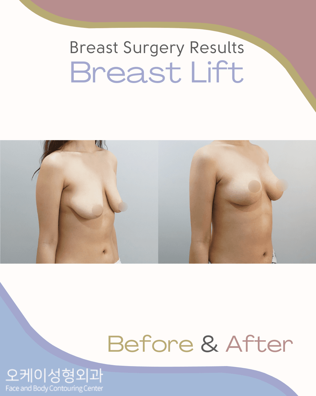 pregnancy induced breast sag korea