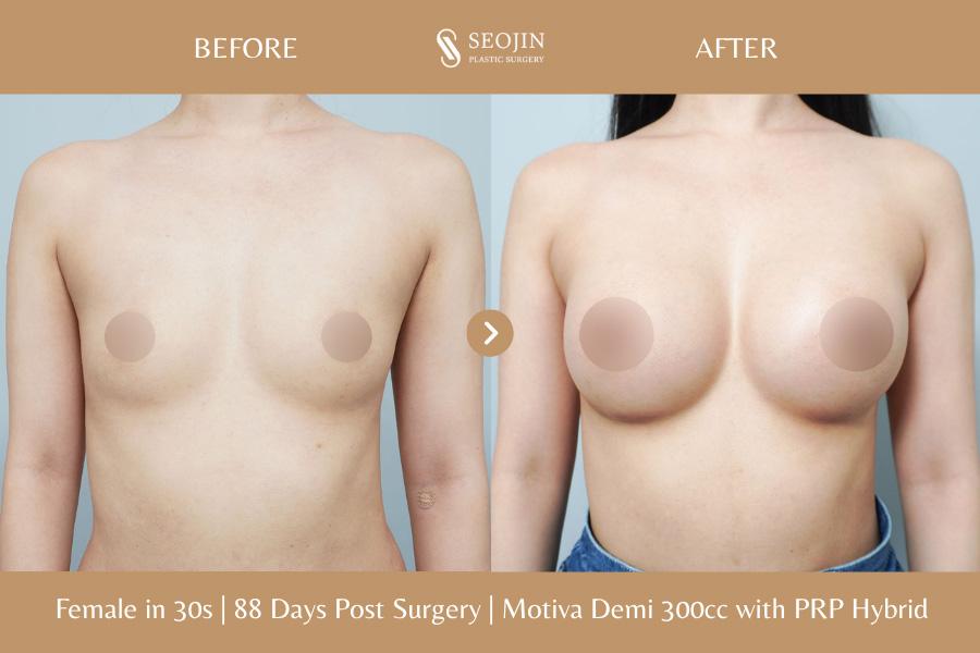 Vorher-Nachher-Bild der Seojin Plastic Surgery Clinic