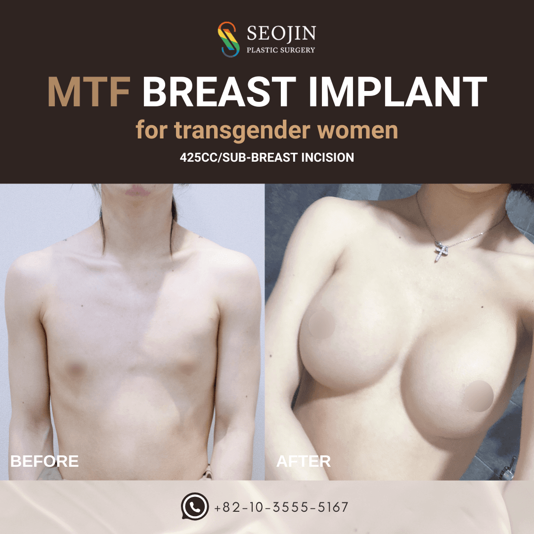 MTF Breast Implant