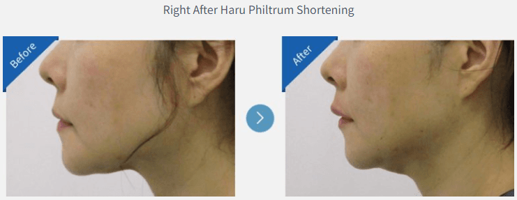 Philtrum shortening before and after 