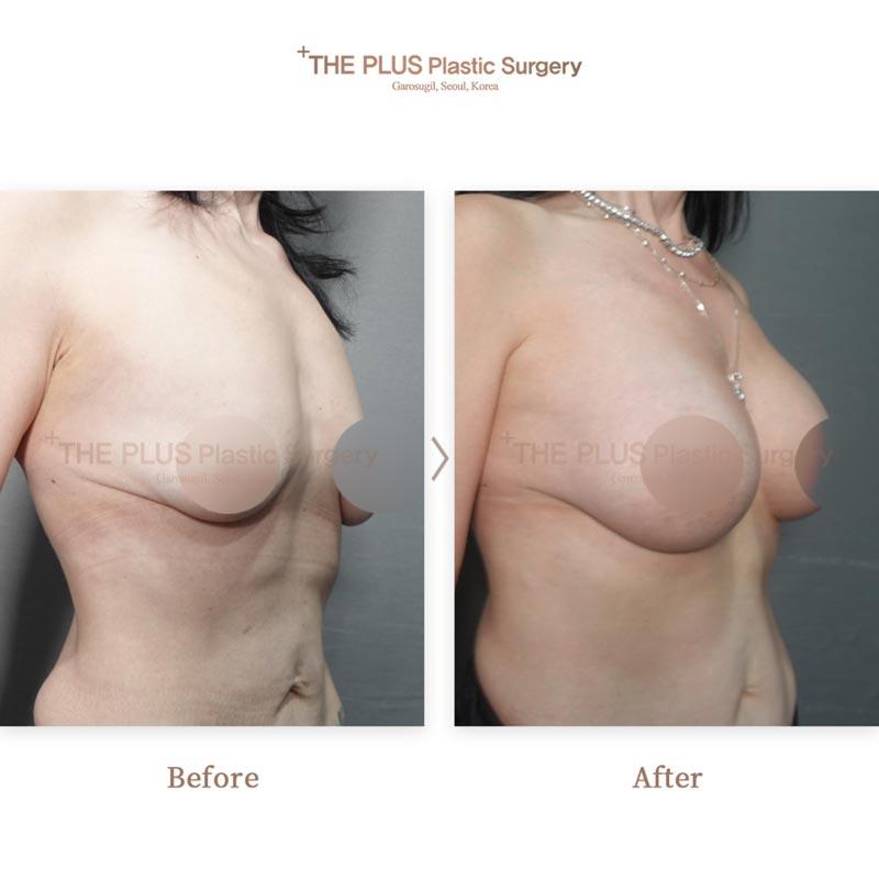Breast Lifting + Breast Implants