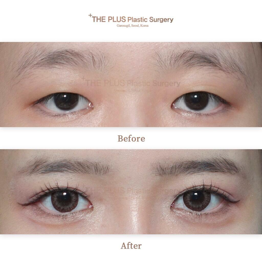 Before and After Ptosis Correction