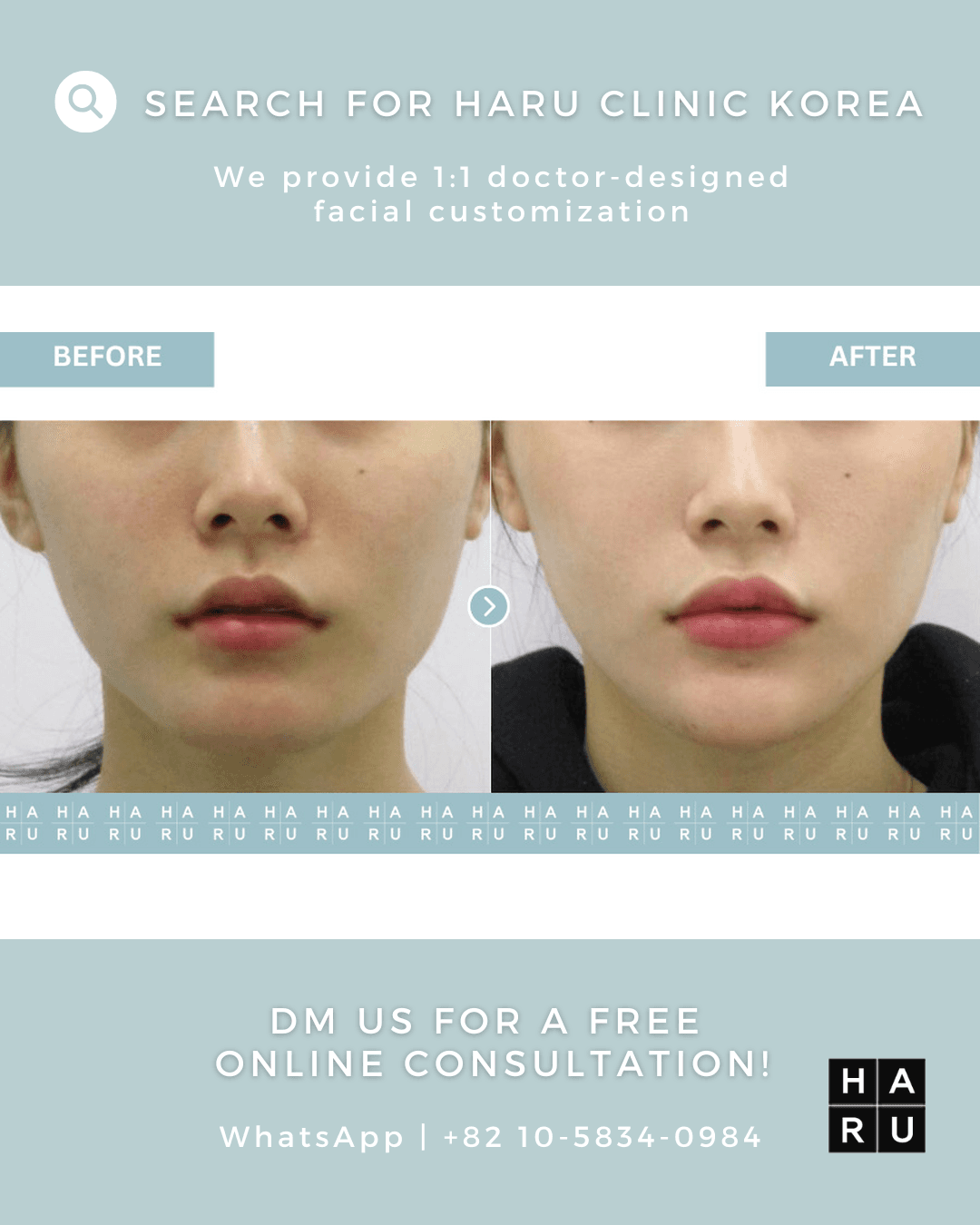 Chin Filler, Chin Botox