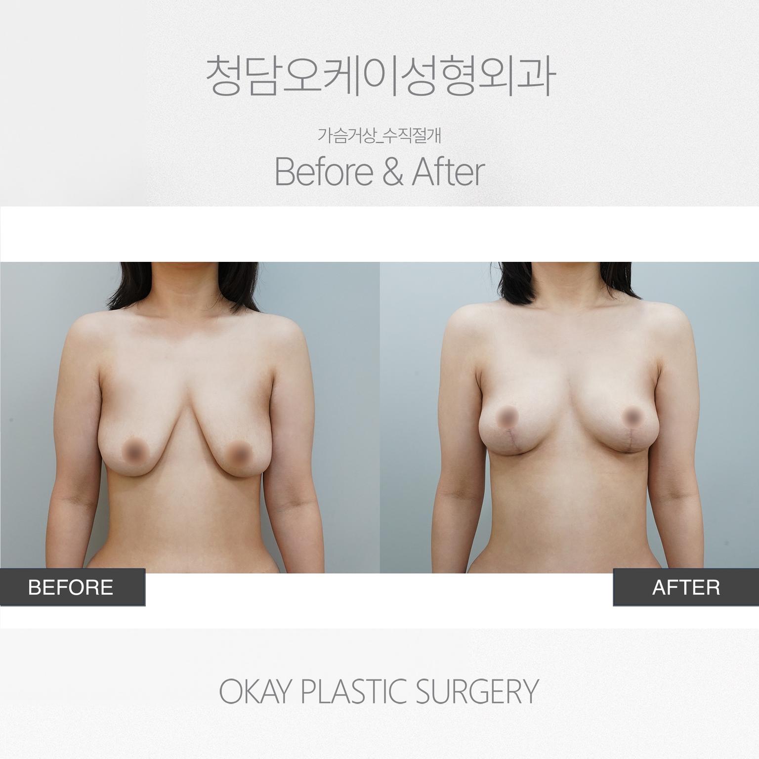 Breast Lift with Vertical Incision Method