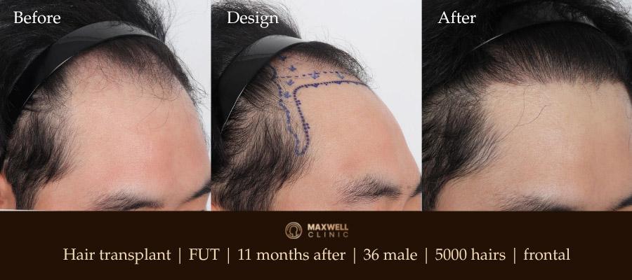 Male frontal
