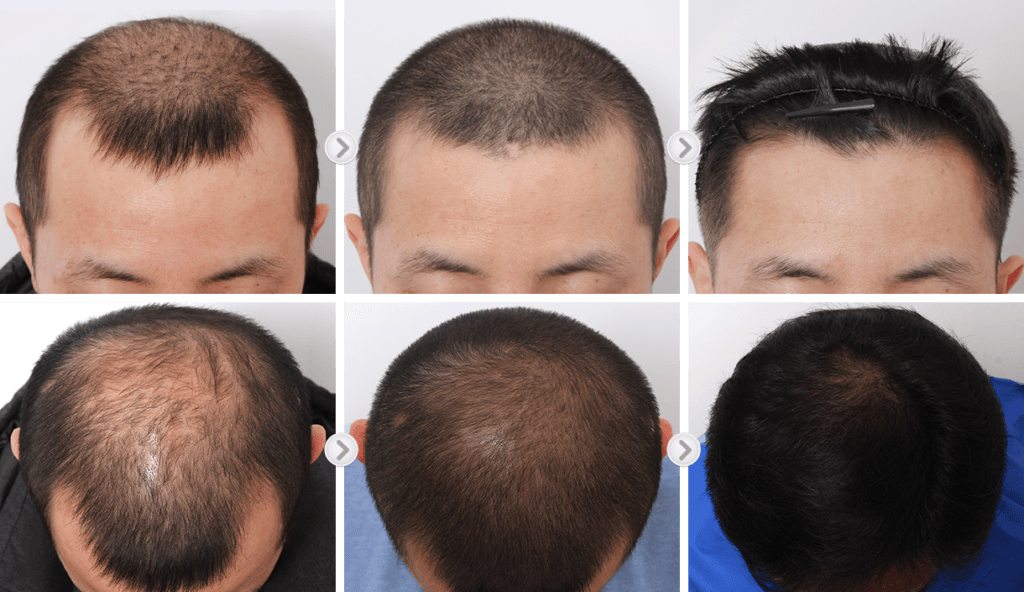 Hair Loss Treatment before after
