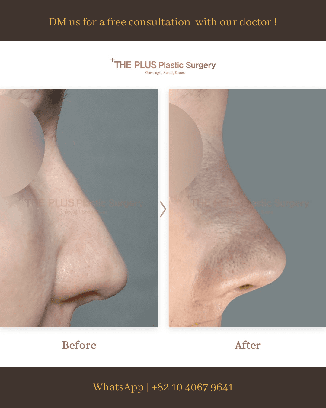 Revision Rhinoplasty, Nose Osteotomy, Rhinitis Surgery
