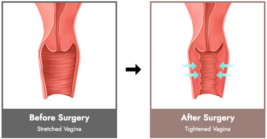 Vaginoplasty
